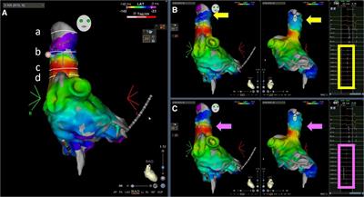 Effective superior vena cava isolation using a novel C-shaped approach